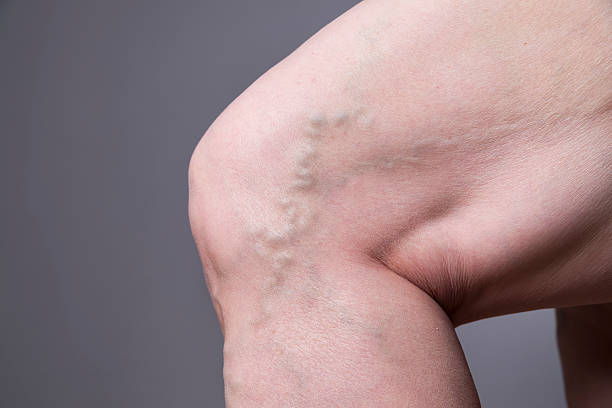 Close-up image of a person's knee showcasing prominent varicose veins against a plain gray background.