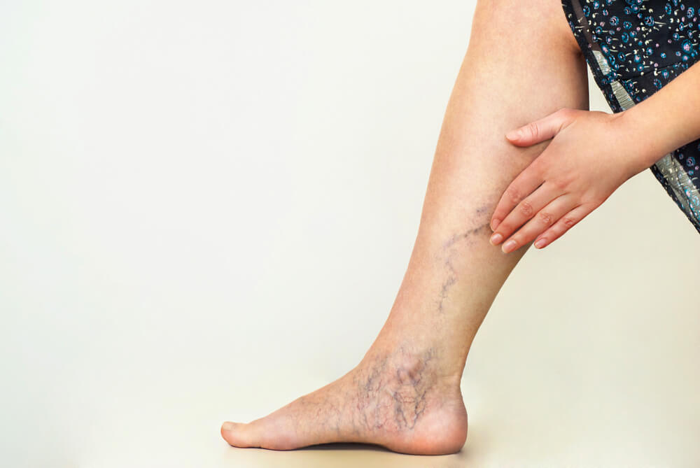 Varicose veins on a woman's leg