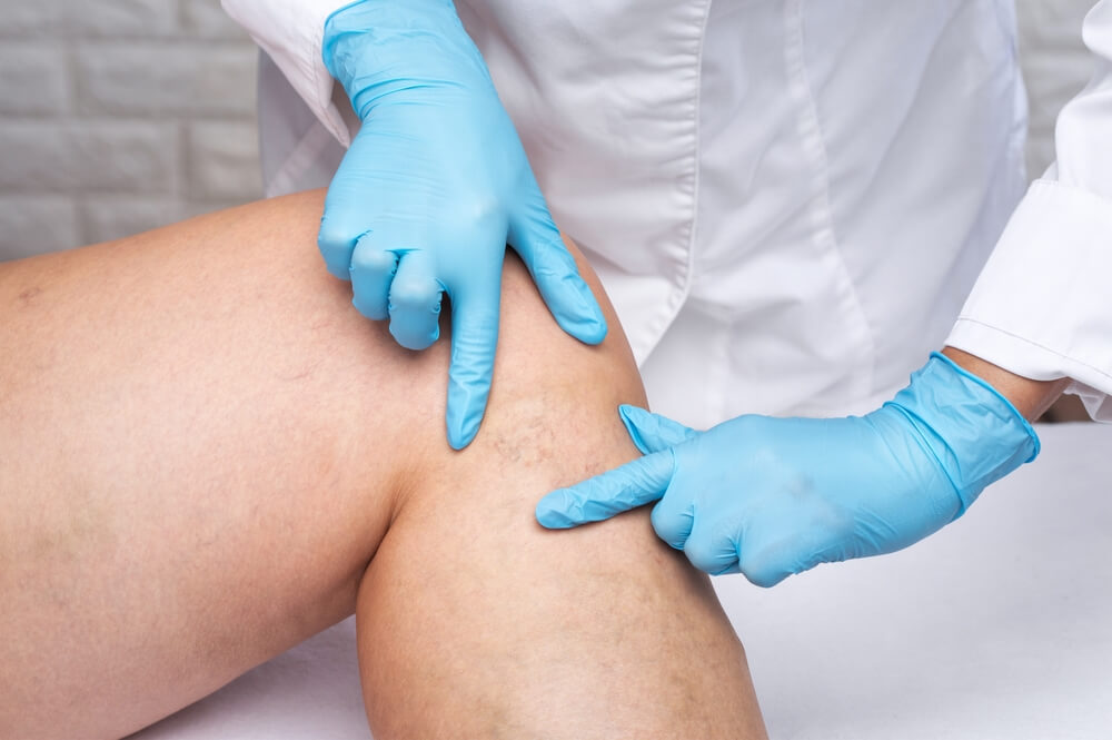 A doctor examining a patient’s lower legs with varicose veins.