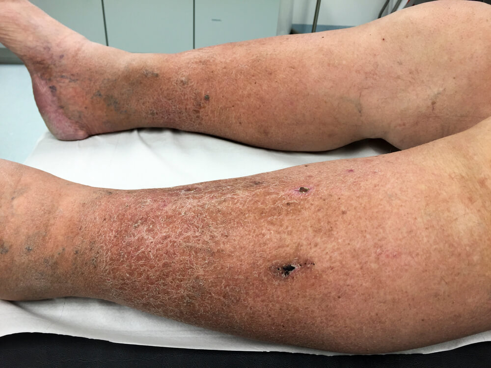 Legs with swelling and discoloration common of Chronic Venous Insufficiency.