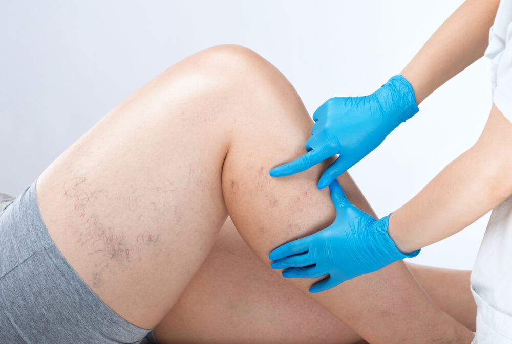 Cleveland vein specialist in blue gloves examines patient’s thigh with visible varicose veins at Nelson Vein clinic, expert treatment for varicose and spider veins.