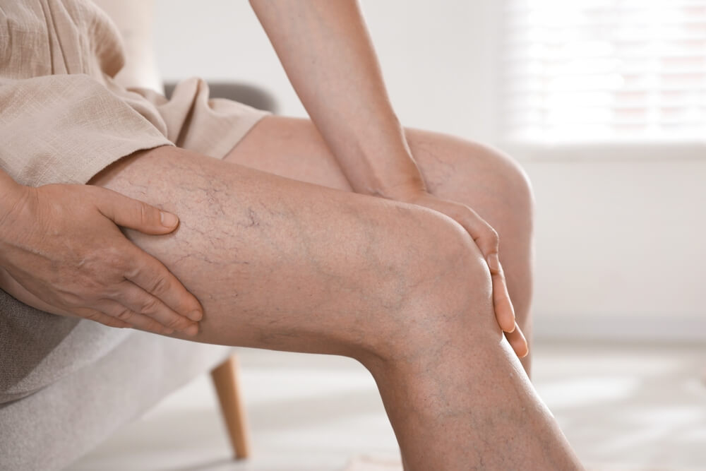 Person seated and holding leg with visible varicose veins under skin, showing vein discomfort; image for Nelson Vein Clinic in Cleveland, Ohio, specialized varicose vein and spider vein treatments.