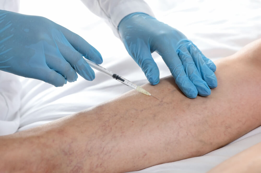 Cleveland Ohio vein treatment specialist administering sclerotherapy injection into patient's leg with visible varicose veins at Nelson Vein clinic; medical professional in blue gloves performing minimally invasive spider vein treatment procedure.