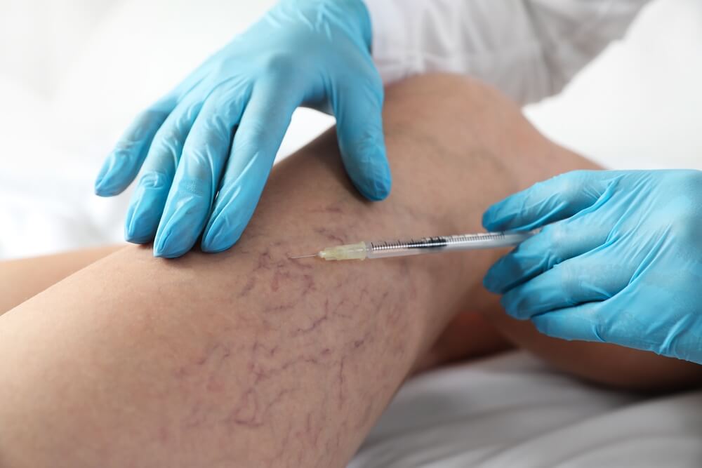 Cleveland vein specialist in blue medical gloves performing expert varicose vein treatment by injecting a needle into a patient’s leg with visible varicose veins at Nelson Vein Clinic.