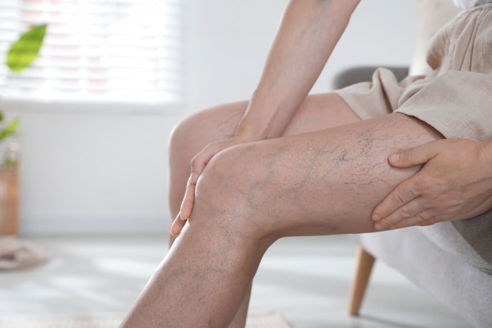 Before leg venefit treatment