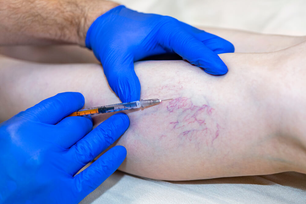 Nelson Vein Cleveland specialist treating varicose veins with minimally invasive injection procedure on patient’s leg.