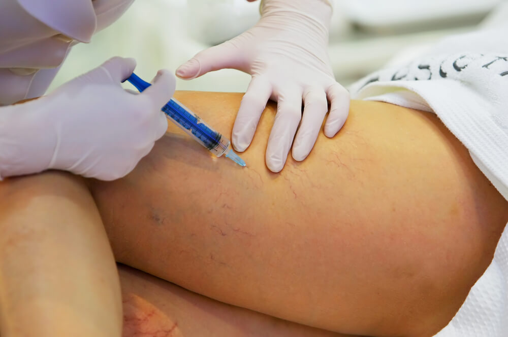 Nelson Vein clinic specialist performing varicose vein injection treatment to improve leg circulation and appearance in Cleveland, Ohio.