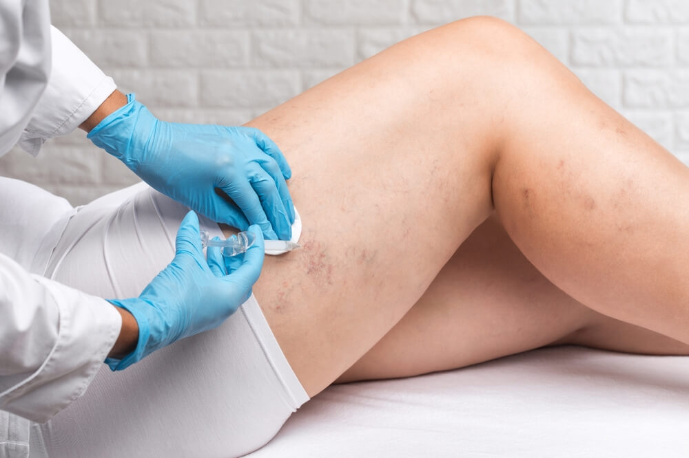 Nelson Vein specialist in Cleveland, Ohio performs sclerotherapy injection for spider veins and varicose vein treatment on patient’s thigh.