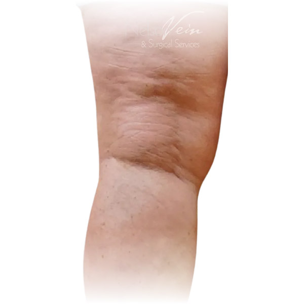 Close-up of back of knee with visible skin folds and mild laxity, ideal for Nelson Vein's Cleveland varicose vein treatment results.