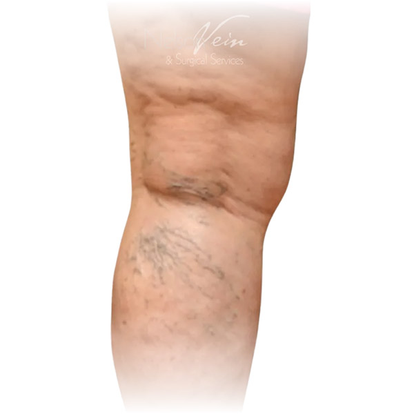 Cleveland patient with varicose veins before Phlebectomy & Sclerotherapy treatment from Dr. Dvora Nelson.