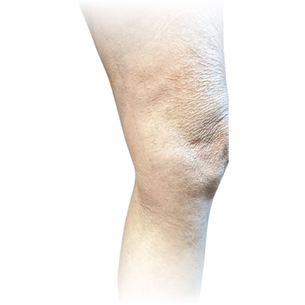 Cleveland patient with varicose veins after Phlebectomy & Sclerotherapy treatment from Dr. Dvora Nelson.