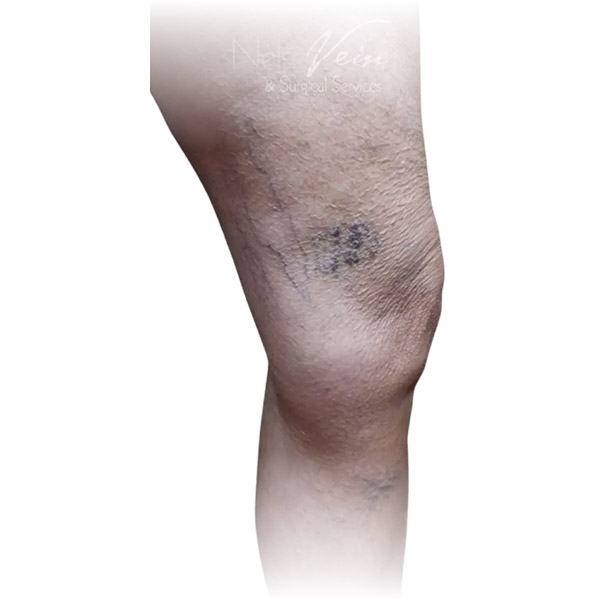 Cleveland patient with varicose veins before Phlebectomy & Sclerotherapy treatment from Dr. Dvora Nelson.