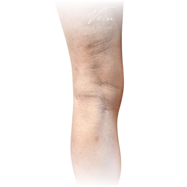 Cleveland patient with varicose veins after Phlebectomy & Sclerotherapy treatment from Dr. Dvora Nelson.
