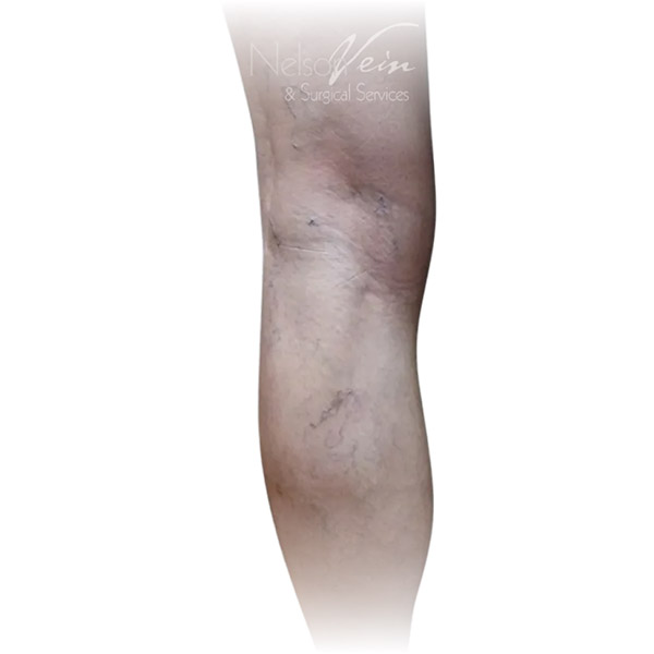 Cleveland patient with varicose veins before Phlebectomy & Sclerotherapy treatment from Dr. Dvora Nelson.