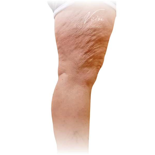 Cleveland patient with varicose veins after Phlebectomy & Sclerotherapy treatment from Dr. Dvora Nelson.