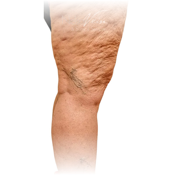 Cleveland patient with varicose veins before Phlebectomy & Sclerotherapy treatment from Dr. Dvora Nelson.