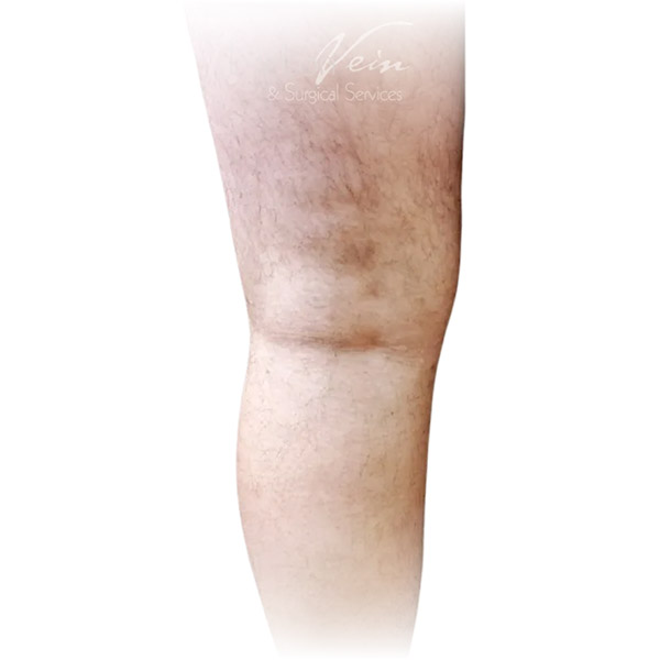 Cleveland patient with varicose veins after Radiofrequency Ablation & Phlebectomy treatment from Dr. Dvora Nelson.