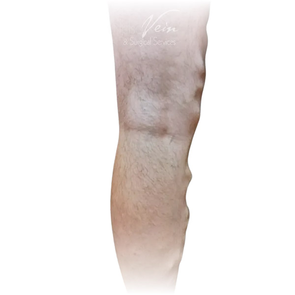 Cleveland patient with varicose veins before Radiofrequency Ablation & Phlebectomy treatment from Dr. Dvora Nelson.