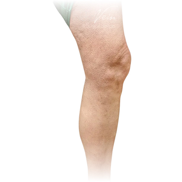 Cleveland patient with varicose veins after Radiofrequency Ablation & Phlebectomy treatment from Dr. Dvora Nelson.