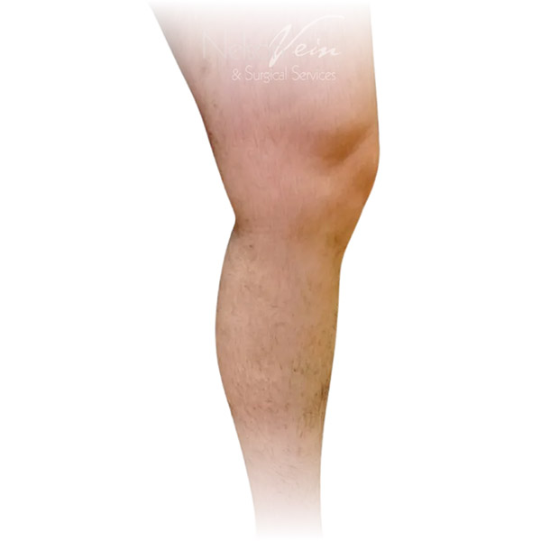Cleveland patient with varicose veins after Radiofrequency Ablation & Phlebectomy treatment from Dr. Dvora Nelson.