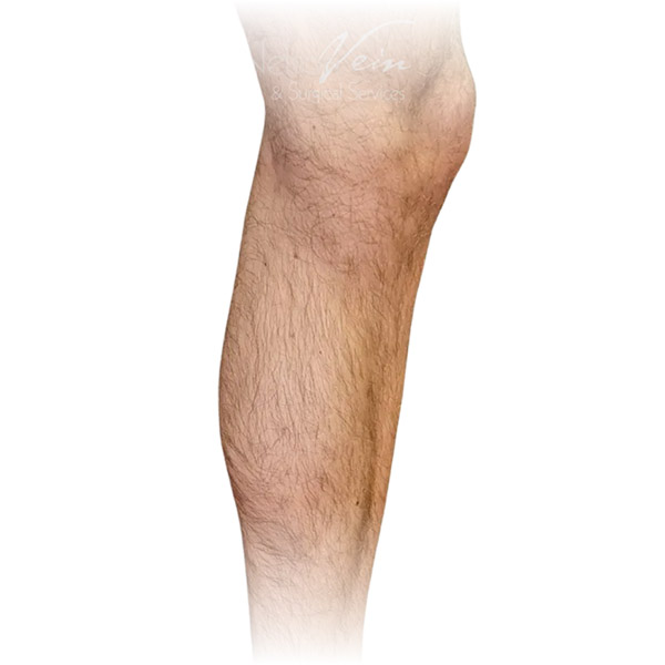Cleveland patient with varicose veins after Radiofrequency Ablation & Phlebectomy treatment from Dr. Dvora Nelson.