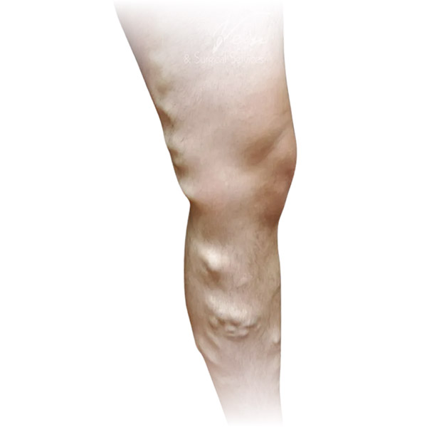 Cleveland patient with varicose veins before Radiofrequency Ablation & Phlebectomy treatment from Dr. Dvora Nelson.