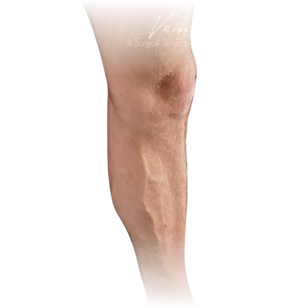 Cleveland patient with varicose veins before Radiofrequency Ablation & Phlebectomy treatment from Dr. Dvora Nelson.