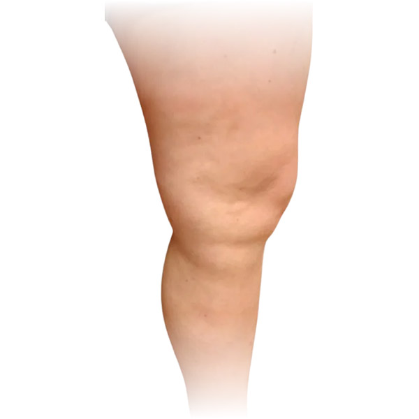 Cleveland patient with varicose veins after Radiofrequency Ablation, Phlebectomy & Sclerotherapy treatment from Dr. Dvora Nelson.