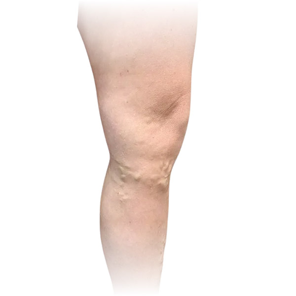 Cleveland patient with varicose veins before Radiofrequency Ablation, Phlebectomy & Sclerotherapy treatment from Dr. Dvora Nelson.
