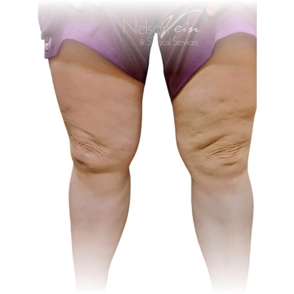 Cleveland patient with varicose veins after Radiofrequency Ablation, Phlebectomy & Sclerotherapy treatment from Dr. Dvora Nelson.