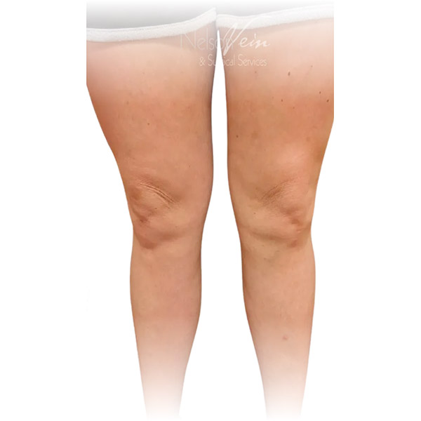 Cleveland patient with varicose veins after Radiofrequency Ablation, Phlebectomy & Sclerotherapy treatment from Dr. Dvora Nelson.