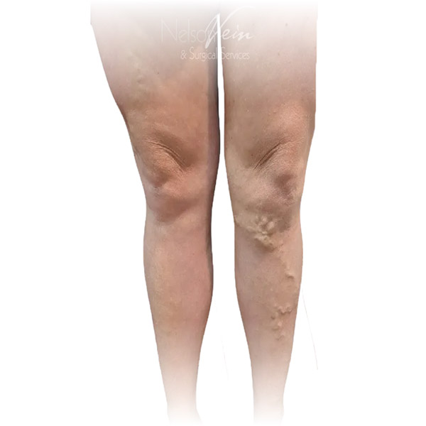 Cleveland patient with varicose veins before Radiofrequency Ablation, Phlebectomy & Sclerotherapy treatment from Dr. Dvora Nelson.