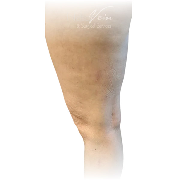 Cleveland patient with varicose veins after Sclerotherapy treatment from Dr. Dvora Nelson.