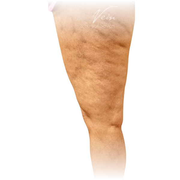 Cleveland patient with varicose veins after Sclerotherapy treatment from Dr. Dvora Nelson.