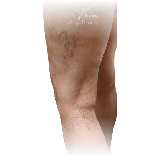 Cleveland patient with varicose veins before Sclerotherapy treatment from Dr. Dvora Nelson.
