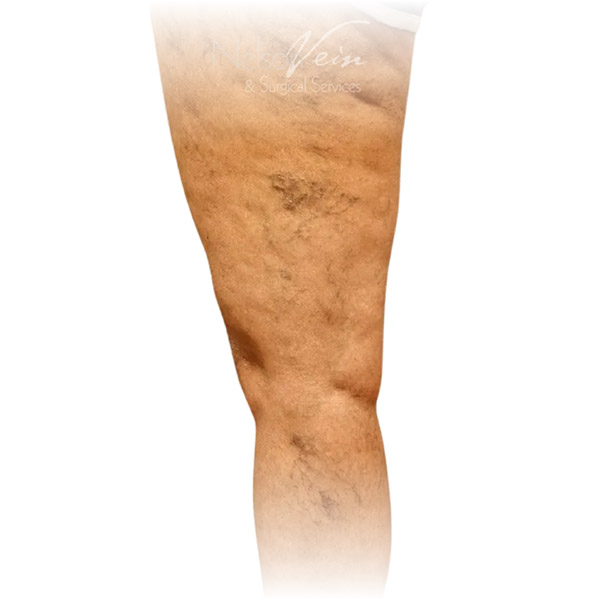 Cleveland patient with varicose veins before Sclerotherapy treatment from Dr. Dvora Nelson.